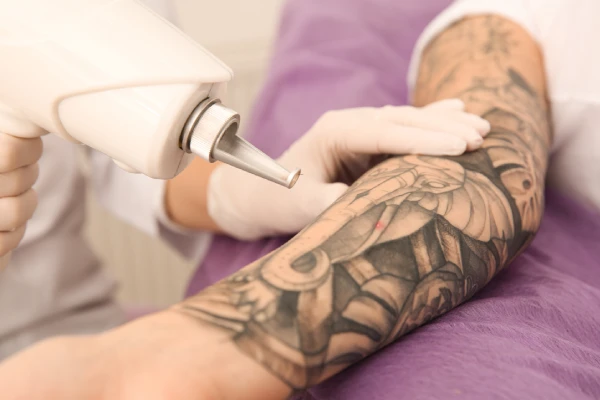 Tattoo Removal